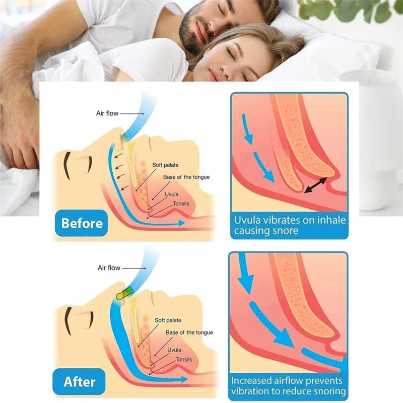 Brezyn™ 2 Anti-Snoring Nasal Device 